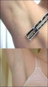 Incizie Axilara la Implant cu Silicon